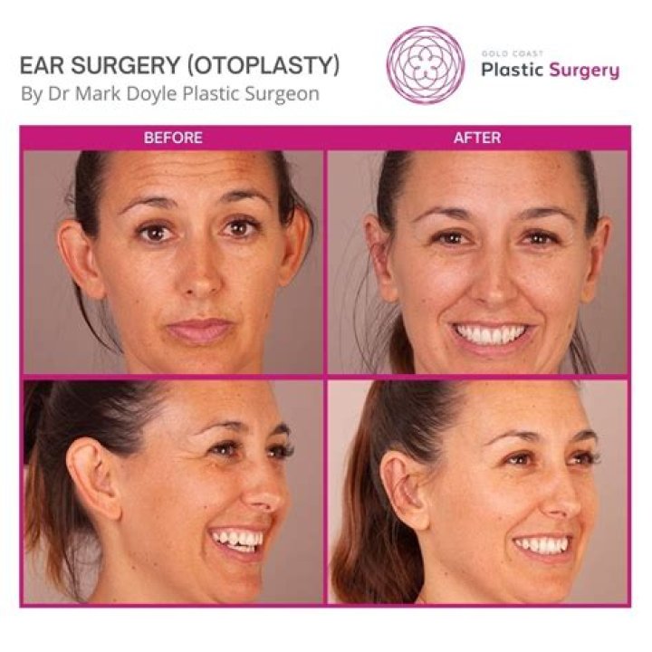 How much does otoplasty cost UK?